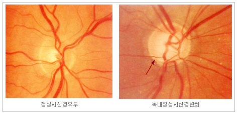 시신경 유두 촬영