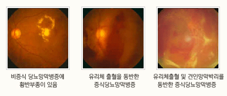 정밀 망막 검사